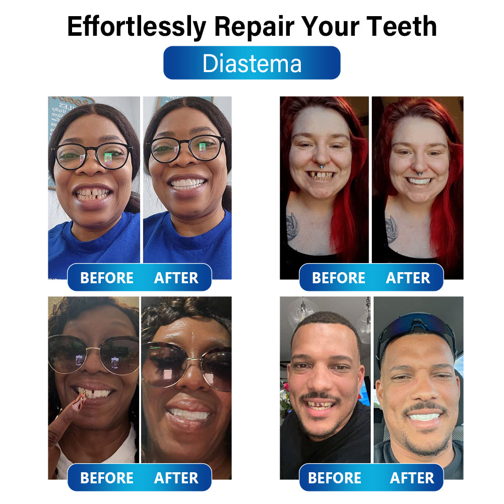 ✅Official Store | Bikenda™ Blue Light Curing Lamp And Dental Restoration Materials 🧑🏼⚕️FDA Approved (For repairing missing teeth, broken teeth, and gaps between teeth)