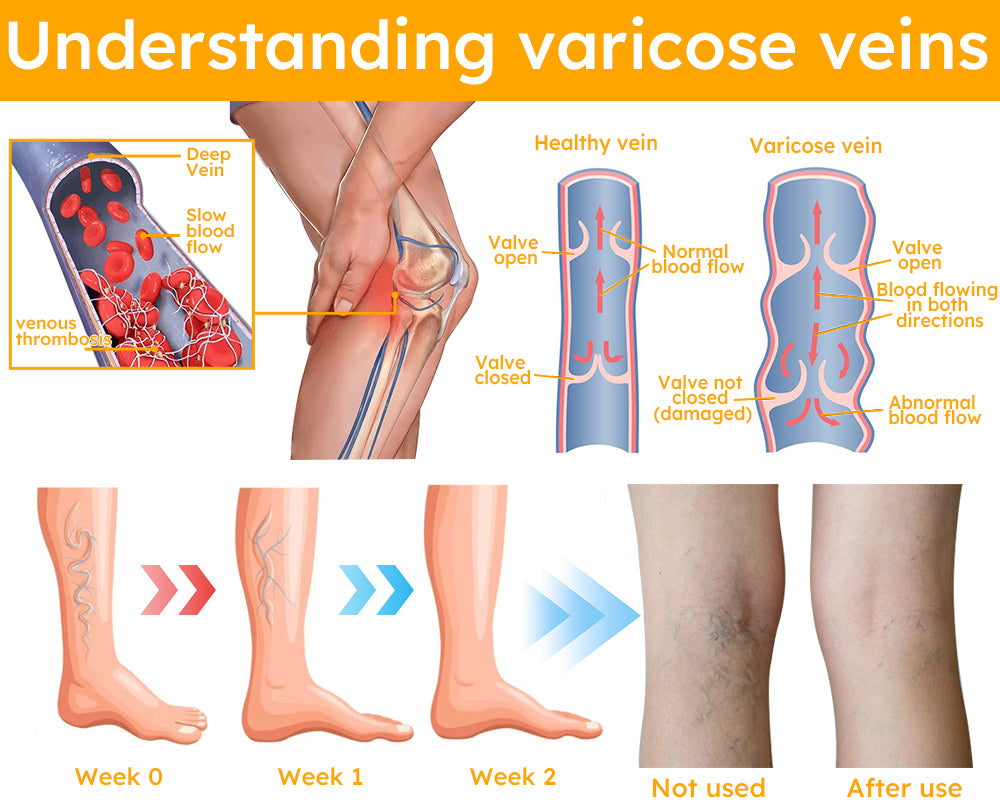 Furzero™ Bee Venom Varicose Veins Spray 🐝