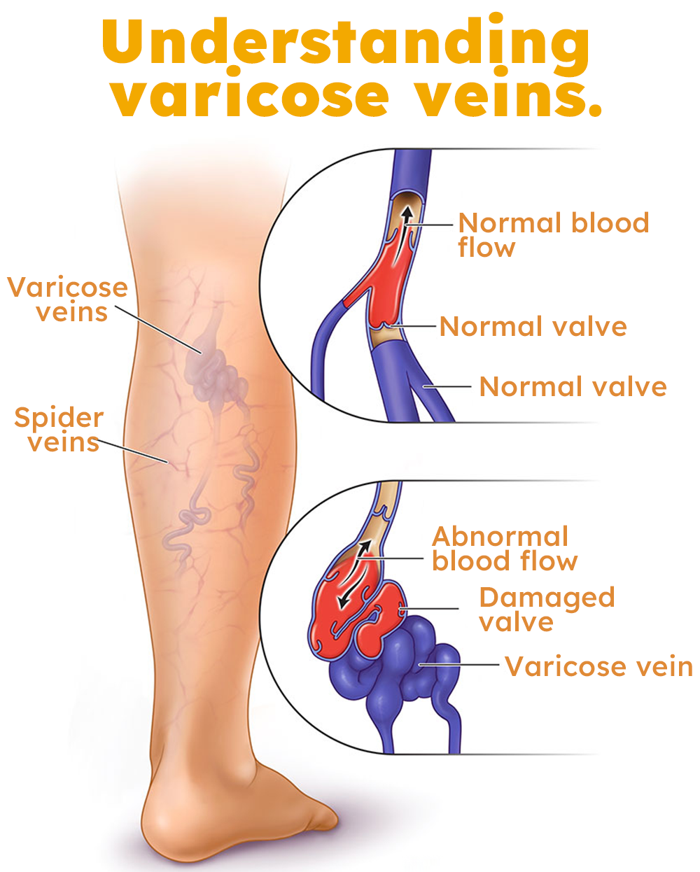 Furzero™ Bees venom varicose veins cream