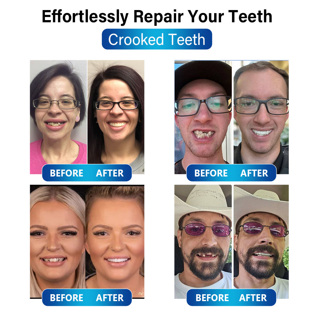 ✅Official Store | Bikenda™ Blue Light Curing Lamp And Dental Restoration Materials 🧑🏼⚕️FDA Approved (For repairing missing teeth, broken teeth, and gaps between teeth)
