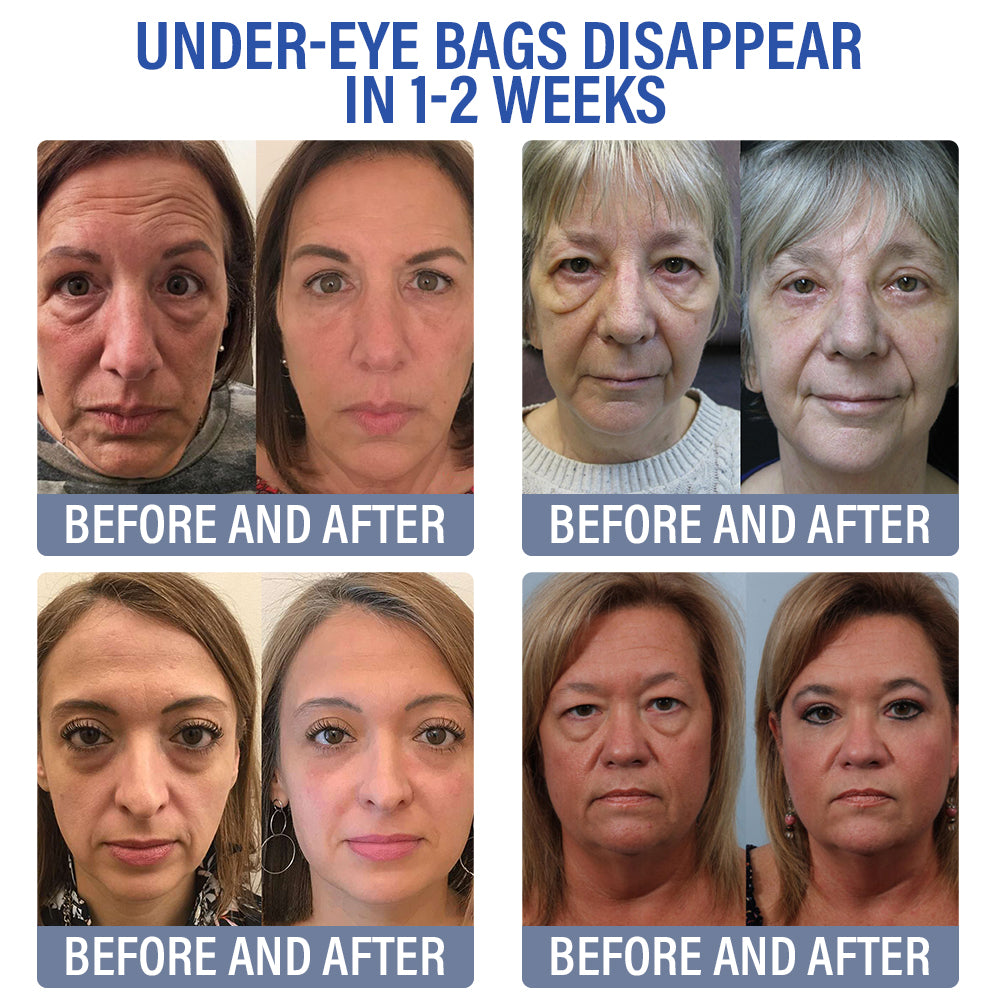 ✅Official Store | flysmus™ Retinol Eye Cream 🧑🏼⚕️Dermatologist Recommended (Eye Cream for Fine Lines, Wrinkles, Dark Circles, Dark Spots, and Daily Anti-Aging)
