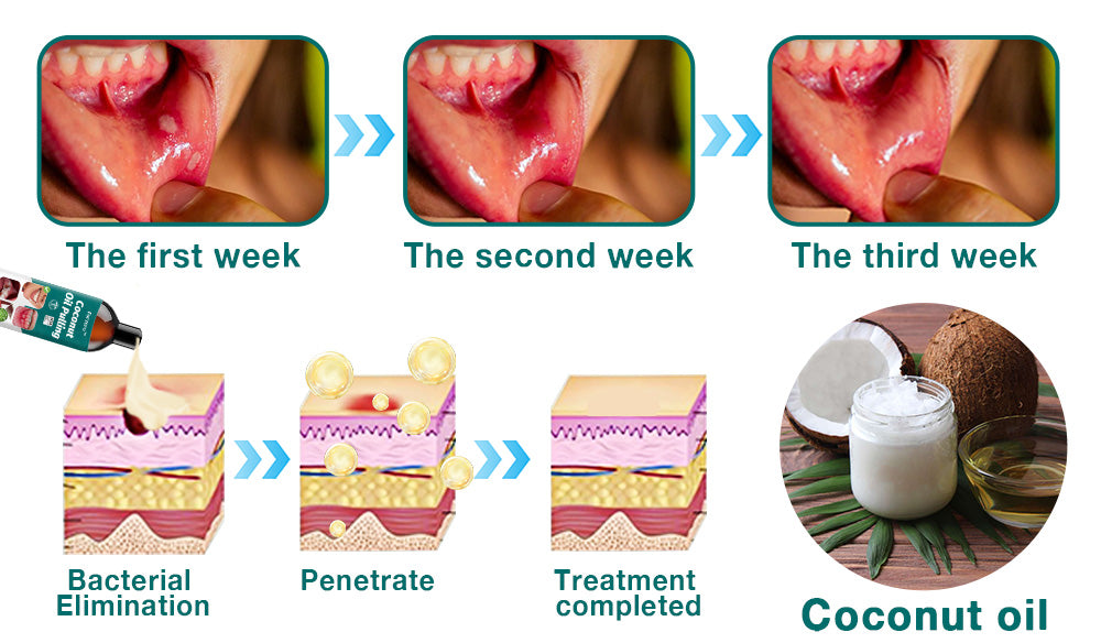 Furzero™ Coconut Oil Pulling (Treating oral ulcers, periodontitis)