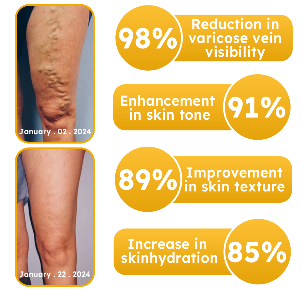 Furzero™ Bees venom varicose veins cream
